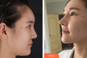 珠海陸達(dá)美容外科醫(yī)院劉仁和整形價(jià)格表附肋骨隆鼻案例展示