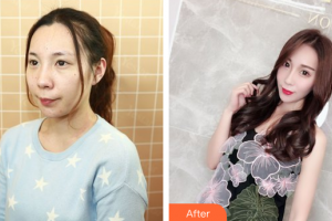 珠海陸達(dá)美容外科醫(yī)院韓淑英整形價(jià)格表附鼻部綜合案例展示