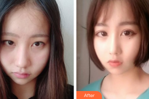 珠海陽光醫(yī)院整形美容中心朱曉東整形價(jià)格表附肋軟骨隆鼻案例展示