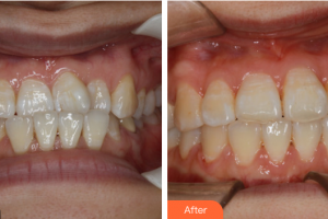 珠海陸達(dá)美容外科醫(yī)院李镕整形價(jià)格表附直絲弓矯正案例展示