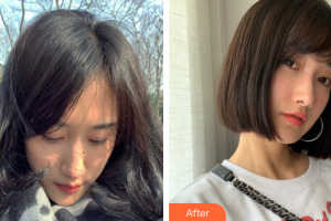 珠海陽光醫(yī)院整形美容中心易菲整形價(jià)格表附去痘印痘坑案例展示