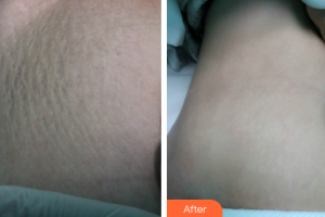 珠海陽光醫(yī)院整形美容中心張敏愛整形價(jià)格表附激光祛妊娠紋案例展示