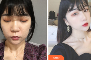 珠海陽光醫(yī)院整形美容中心鄧宇茜整形價(jià)格表附去痘印痘坑案例展示