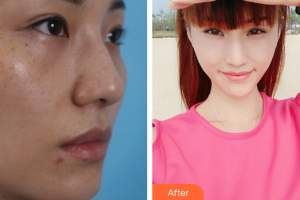 珠海方華醫(yī)院醫(yī)學(xué)美容科方明整形價(jià)格表附激光祛斑案例展示