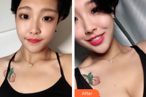 珠海市人民醫(yī)院燒傷整形綜合科羅文福整形價(jià)格表附自體脂肪隆胸案例展示