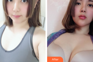珠海新顏醫(yī)療美容診所朱占魁整形價(jià)格表附自體脂肪隆胸案例展示