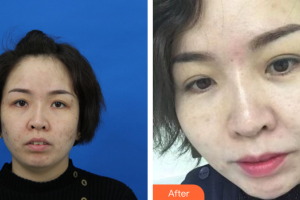 珠?；輴坩t(yī)院整形美容科陳曉華整形價(jià)格表附微針美膚案例展示