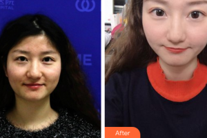 珠?；輴坩t(yī)院整形美容科董仲琴整形價(jià)格表附微針美膚案例展示