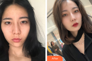 珠海陽光醫(yī)院整形美容中心周輝整形價(jià)格表附超激光美膚美白祛斑案例展示