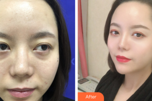 珠?？泼泪t(yī)療美容醫(yī)院李金瓊整形價(jià)格表附私人訂制童顏術(shù)基礎(chǔ)版案例展示