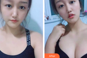 珠海科美醫(yī)療美容醫(yī)院張民望整形價(jià)格表附自體脂肪隆胸案例展示