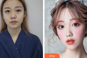 珠海海大整形美容外科黃發(fā)整形價(jià)格表附埋線雙眼皮案例展示