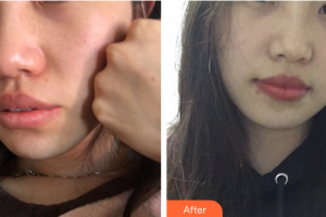 珠海萊茵醫(yī)療美容醫(yī)院權(quán)競(jìng)元整形價(jià)格表附光子嫩膚案例展示