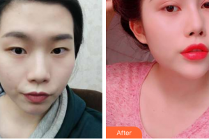 珠海陸達(dá)美容外科醫(yī)院楊榮坤整形價(jià)格表附雙眼皮案例展示