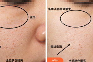 珠海陸達(dá)美容外科醫(yī)院黃志紅整形價(jià)格表附激光祛斑案例展示