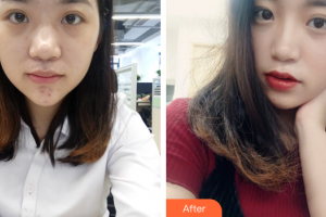 珠海九龍醫(yī)院醫(yī)學(xué)美容科鐘小榮整形價(jià)格表附清潔祛痘案例展示