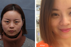 珠海吉大郭閆伏醫(yī)療美容診所林德金整形價(jià)格表附眼部整形案例展示