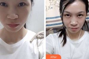 珠?；輴?ài)醫(yī)院整形美容科羅艷紅整形價(jià)格表附眼部修復(fù)案例展示