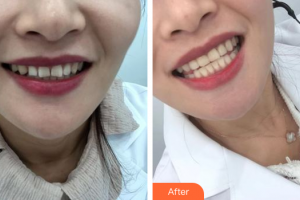 珠海愛(ài)思特醫(yī)療美容醫(yī)院韓繼新整形價(jià)格表附口腔美白貼面案例展示