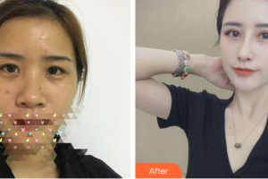 珠海藝星（原仁愛(ài)）醫(yī)療美容門(mén)診部趙世平整形價(jià)格表附眼鼻部手術(shù)案例展示