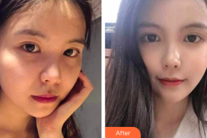 珠海藝星（原仁愛(ài)）醫(yī)療美容門(mén)診部郭長(zhǎng)元整形價(jià)格表附熱瑪吉案例展示