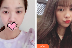 珠海藝星（原仁愛(ài)）醫(yī)療美容門(mén)診部齊小玲整形價(jià)格表附切開(kāi)雙眼皮案例展示