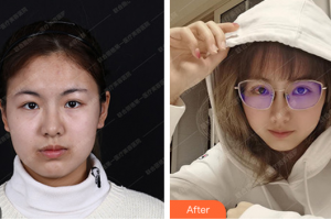 珠海微創(chuàng)外科醫(yī)院金涥澤整形價(jià)格表附切開(kāi)雙眼皮案例展示