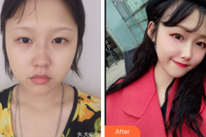 珠海陽(yáng)光醫(yī)院整形美容中心謝秋萍整形價(jià)格表附埋線提升案例展示