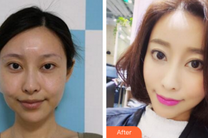 珠海美涵醫(yī)療美容門(mén)診部邵偉整形價(jià)格表附埋線提升案例展示