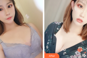 珠海美涵醫(yī)療美容門(mén)診部李春雷整形價(jià)格表附自體脂肪隆胸案例展示