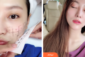 珠海微創(chuàng)外科醫(yī)院黃镕碩整形價(jià)格表附熱瑪吉案例展示