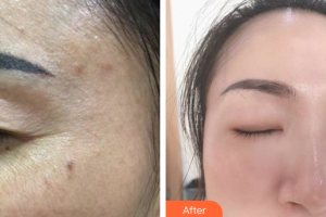 珠海韓妃醫(yī)療美容門診部李友良整形價(jià)格表附超激光美膚祛斑案例展示