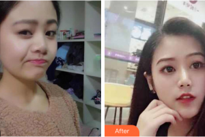 珠海艾瑞醫(yī)療美容醫(yī)院熊學(xué)俊整形價(jià)格表附自然小翹鼻案例展示