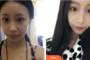 珠海艾瑞醫(yī)療美容醫(yī)院胡國(guó)華整形價(jià)格表附鼻部手術(shù)案例展示