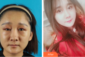 珠海吉大郭閆伏醫(yī)療美容診所張明興整形價(jià)格表附鼻部手術(shù)+埋線提升案例展示