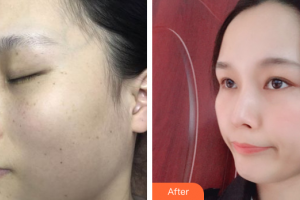 珠海新顏醫(yī)療美容診所何奎整形價(jià)格表附激光美膚激光案例展示