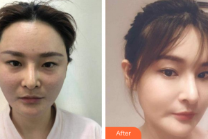 珠海吉大郭閆伏醫(yī)療美容診所薛博今整形價(jià)格表附埋線提升案例展示