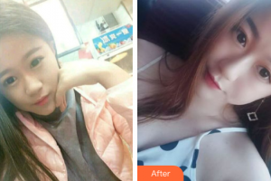 珠海吉大郭閆伏醫(yī)療美容診所郭秉霖整形價(jià)格表附白瓷娃娃案例展示