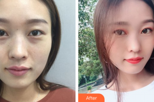 珠海韓妃醫(yī)療美容門診部項(xiàng)曉飛整形價(jià)格表附鼻部手術(shù)案例展示