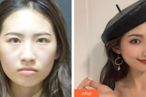 珠海藝星（原仁愛）醫(yī)療美容門診部潘智軒整形價(jià)格表附鼻部多項(xiàng)案例展示