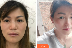 珠海蒂伊醫(yī)療美容門診部石巍巍整形價(jià)格表附激光祛斑案例展示