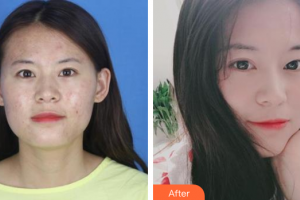 珠海蒂伊醫(yī)療美容門診部林戈亮整形價(jià)格表附微針祛痘案例展示