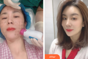 珠海蒂伊醫(yī)療美容門診部廖俊凱整形價(jià)格表附熱瑪吉案例展示