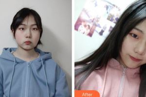 珠海愛思特醫(yī)療美容醫(yī)院周潔松整形價(jià)格表附埋線提升案例展示