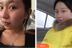 珠海愛思特醫(yī)療美容醫(yī)院李晶整形價(jià)格表附光子嫩膚案例展示