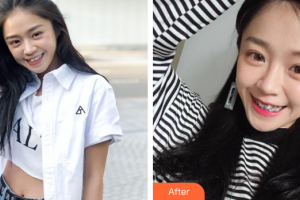 珠海拜博口腔醫(yī)院曾皓整形價(jià)格表附金屬矯正案例展示