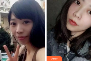 珠海拜博口腔醫(yī)院韓德志整形價(jià)格表附自鎖矯正案例展示