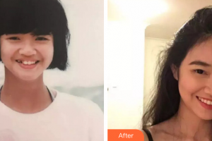 珠海拜博口腔醫(yī)院鄧勝靈整形價(jià)格表附金屬矯正案例展示