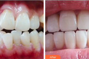 珠海拜博口腔醫(yī)院張勁波整形價(jià)格表附口腔牙齒矯正案例展示