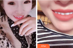 珠海拜博口腔醫(yī)院馮慧韻整形價(jià)格表附冷光美白案例展示